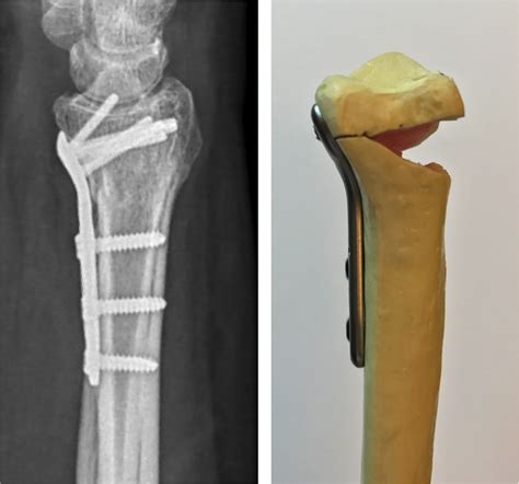 boxing with metal plate in wrist|Recovering from a Distal Radius Fracture .